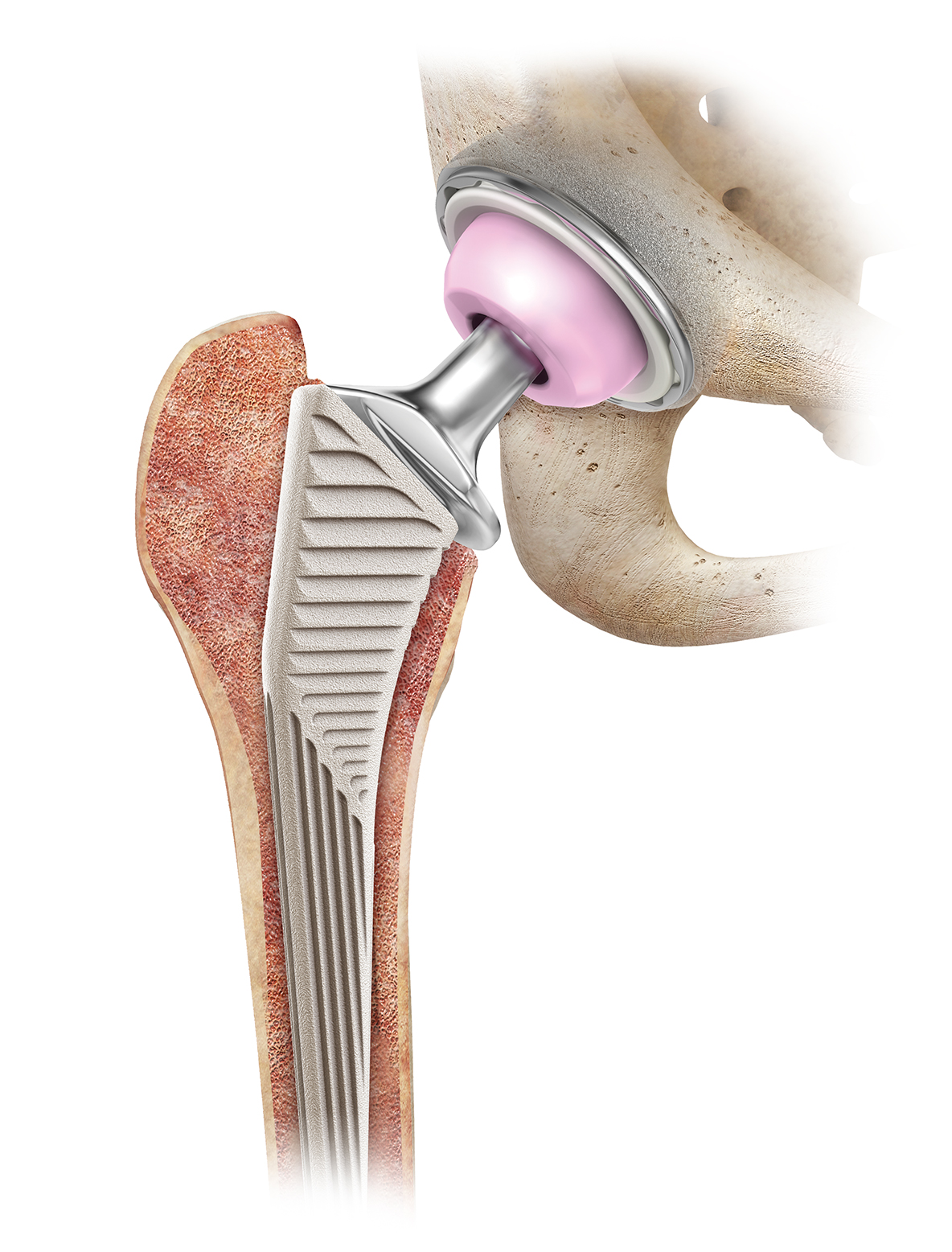 Total Hip Replacement - Anterior Approach