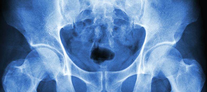Digital X-ray