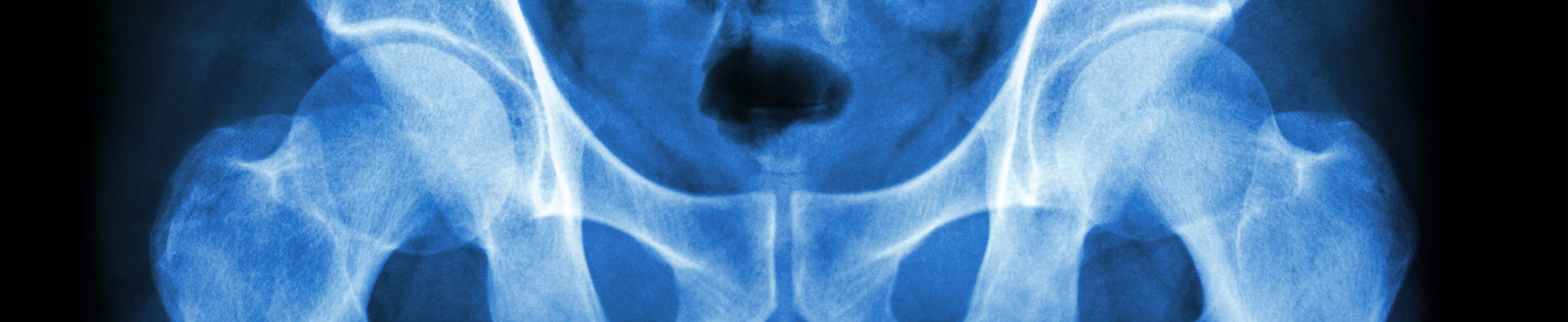 Total Hip Replacement