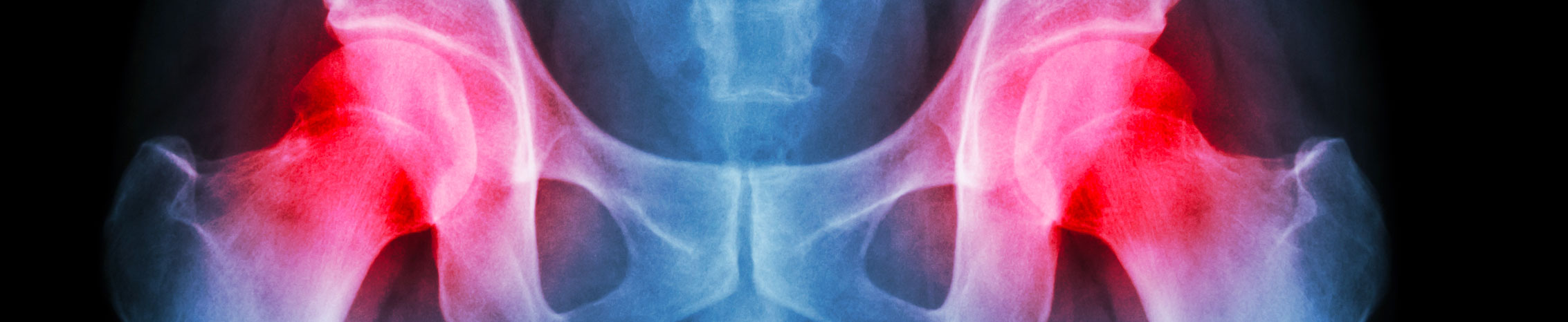 Total Hip Replacement