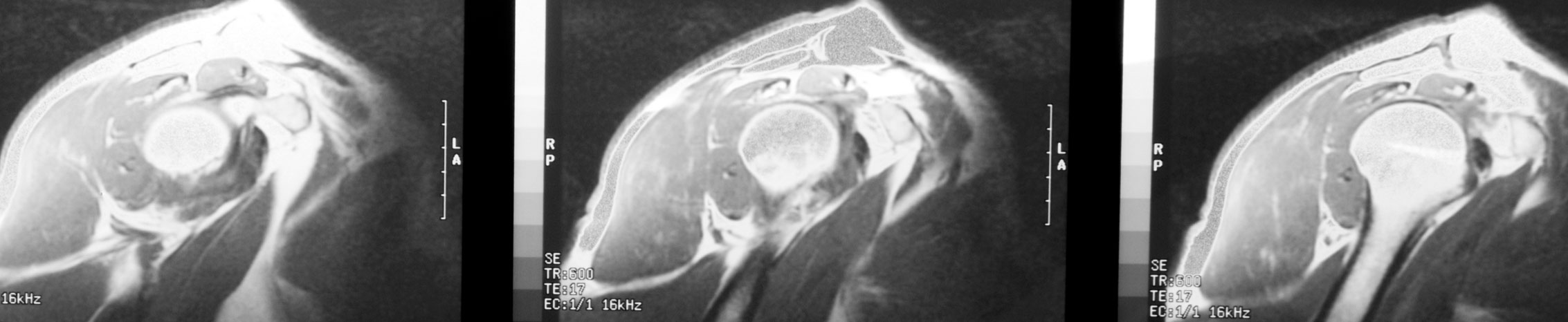 Total Shoulder Replacement