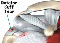 Rotator Cuff Tear